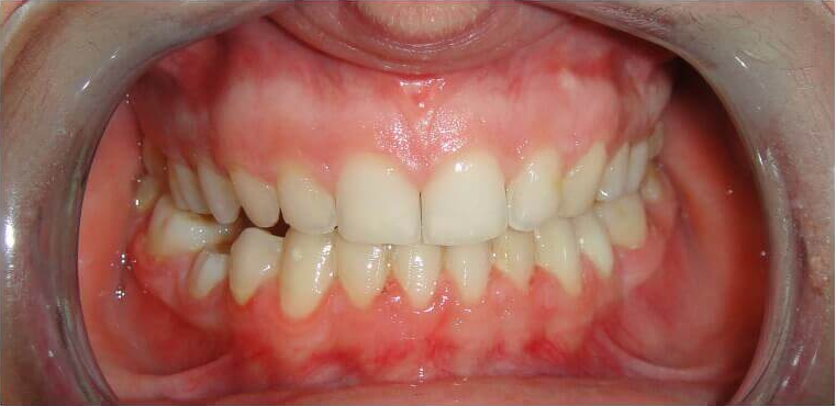 Pred a Po výsledky ortodoncie Ortho Keep Smiling