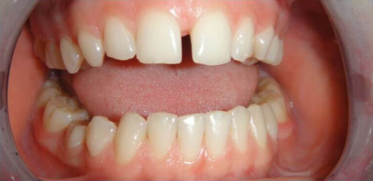 medzery medzi zubami
