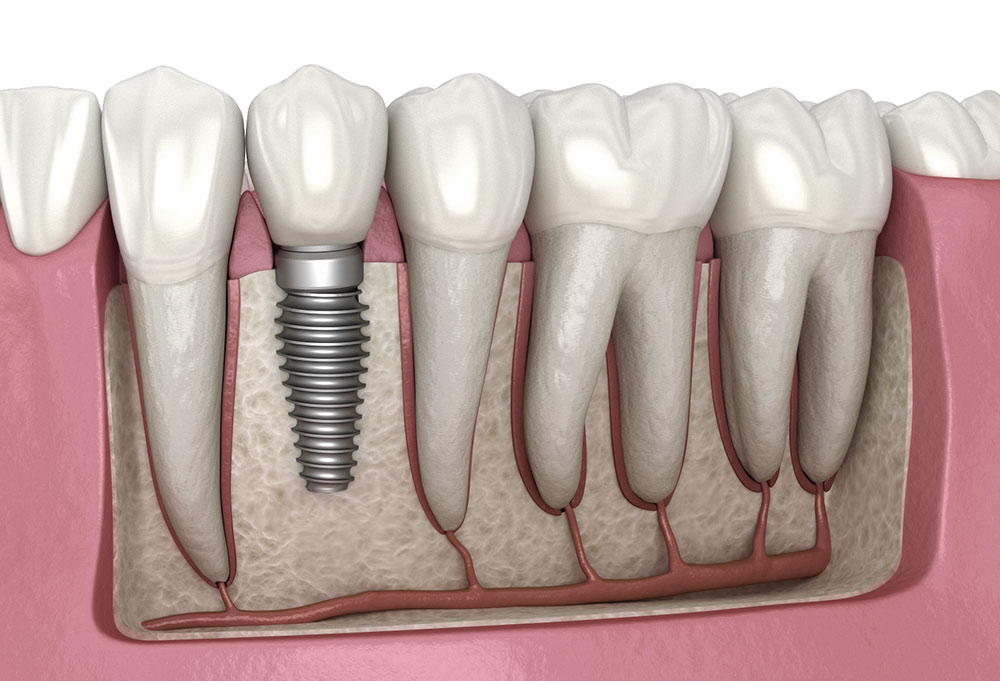 zubny implantat